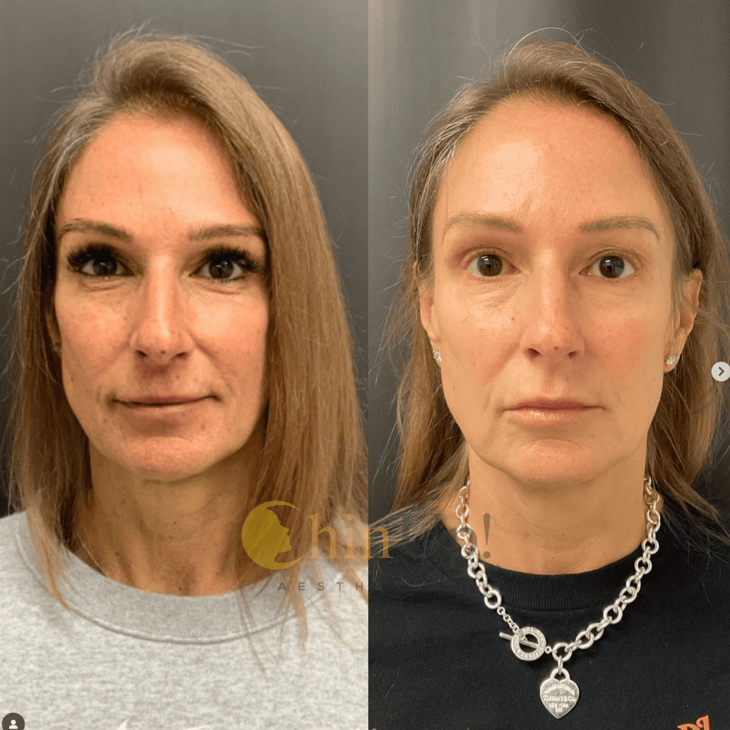 Is there anything better than this natural result that will just continue to improve with time?! Sculptra is a powerful product that contains Poly-L-Lactic Acid